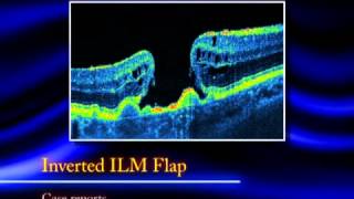 The Inverted ILM Flap Technique for Large Macular Holes