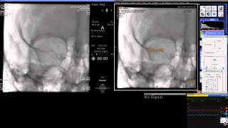 Y-stent-assisted coil embolization of cerebral aneurysms