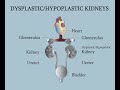 hipoplasia y displasia de los riñones renal