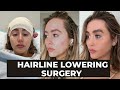 HAIRLINE LOWERING SURGERY VLOG + thread lift removal