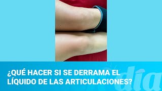 ¿Qué hacer si se derrama el líquido de las articulaciones?