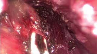 TOETVA : Trans Oral Endoscopic Thyroidectomy Vestibular Anterior