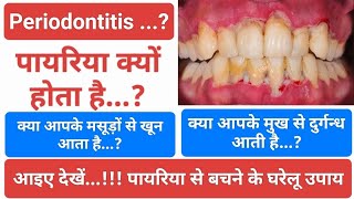 Periodontitis...? पायरिया क्यों होता है...? आइए देखें...! पायरिया से बचने के घरेलू उपाय #पायरिया