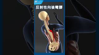 【自診自醫】打噴痴或咳嗽會腰腿麻痛?(B18b)(3D Animation)