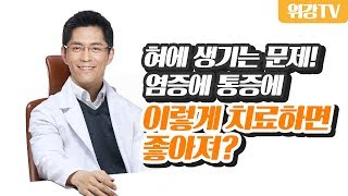 구내염, 설통, 구강 작열감 증후군 등 혀 질환 원인과 치료 _ 위강한의원 수원점