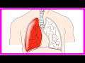 Was ist eine lungenembolie? symptome, ursachen, folgen