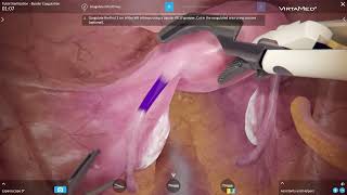 VirtaMed LaparoS™ - Tubal Sterilization Bipolar Coagulation