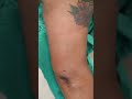 Arm Liposuction result #shorts #viralshort