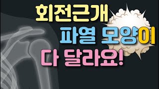 회전근개파열 시리즈 17 - 회전근개파열 모양에 따른 설명