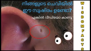 ചെവിയിയിലെ ഈ ദ്വാരത്തിന് കാരണം | What's the Small hole in Ear