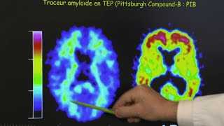 Santé - Mieux connaitre Alzheimer