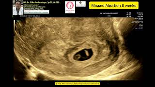 Missed Abortion 8 weeks..