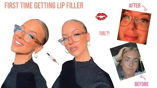 FIRST TIME GETTING LIP FILLER!?!? 1ML Before, During and After Vlog HONEST experience