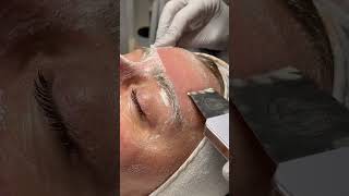 Ultrasound Peel at Upper West Spa