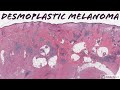 Desmoplastic Melanoma: 5-Minute Pathology Pearls