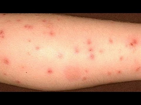 How to get rid of bed bug bites How to get rid of bed bug bites