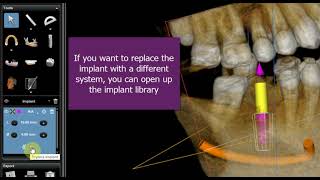 Using CS 3D Imaging Software for Implant Planning