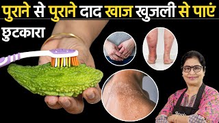 सिर्फ 3 दिन में पुराने दाद, खाज, खुजली को दूर करने का सबसे सफल उपाय | Ringworm Treatment Naturally