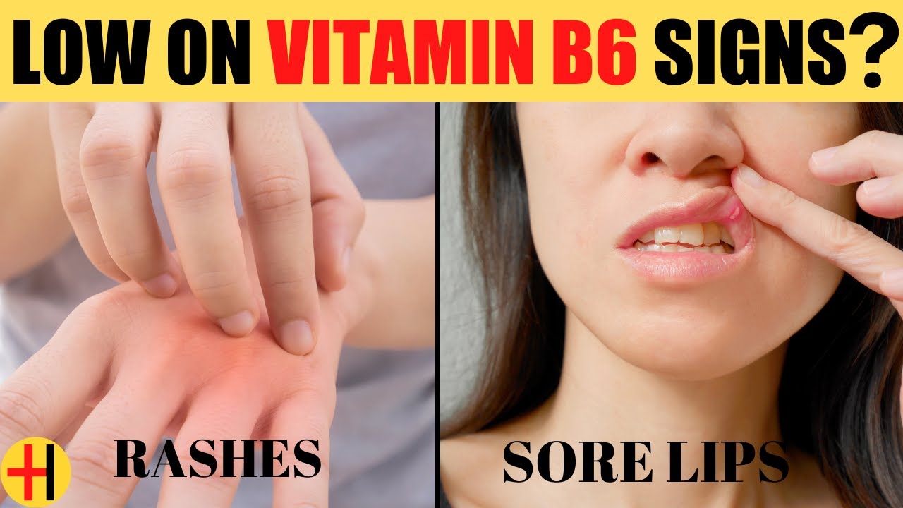 Vitamin B6 (Pyridoxine) Deficiency Symptoms | Signs You Have Vitamin B6 ...