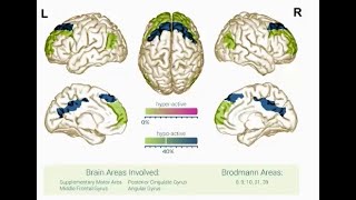 qEEG Profile Report