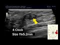 breast multiple fibroadenomas positioning according to breast clock ultrasound