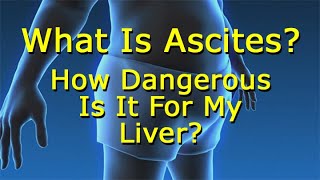 What Is Ascites And How Dangerous Is It For My Liver?