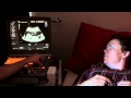 Nuchal Translucency Scan - First Trimester