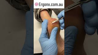 Severely painful cracked bleeding heel fissure treatemnt in podiatry clinic