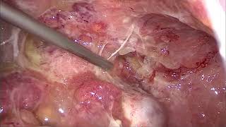 TBC PERITONEAL: LAPAROSCOPIA EXPLORATORIA  + TOMA DE BIOPSIA. HNHU