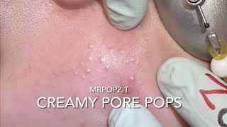 Creamy Pore Pops. Acne extractions. Blackheads, whiteheads. Edited down for just the pops. Pore dirt