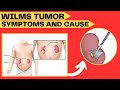 Wilms Tumor Symptoms and Causes of Wilms Tumor and Treatment Your Doctor