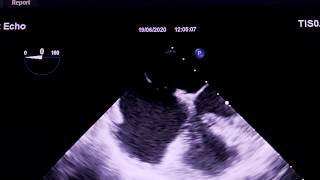 Echocardiogram - atrial septal defect (ASD).