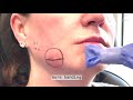 Dallas Kybella Procedure for Jowls by Dr. Lam