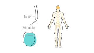 How Spinal Cord Stimulators Works
