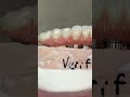 great mono zirconia teeth dental smile lsk121shorts shortvideo shorts