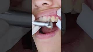 Amazing \u0026 satisfying braces removal with sounds - Braces Off w/ TheBracesDoc