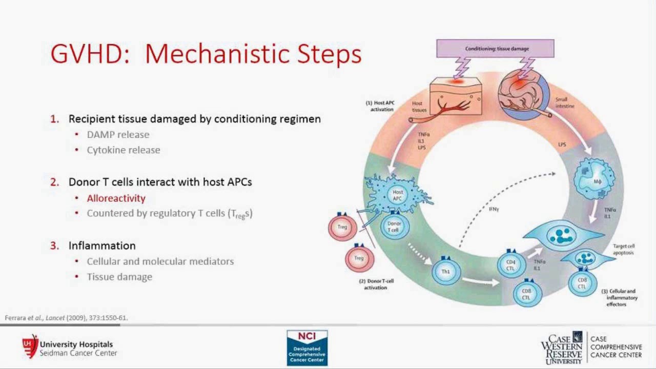 “Building A Graft Vs. Host Disease Program At UH Seidman Cancer Center ...