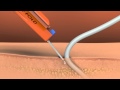 SecurAcath Animation 2