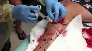 Part 2 Laceration Repair