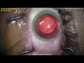 cataractcoach™ 1892 video contest 3rd place winner punctured capsule