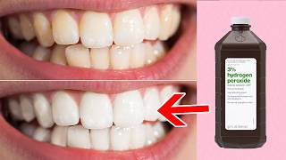 Does Hydrogen Peroxide Whiten Teeth?