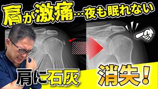 激痛！肩石灰沈着性腱板炎の原因と治療法　【年間6万人診察の整形外科医が徹底解説】