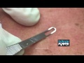 more back blackheads one of my first patients i videotaped has returned