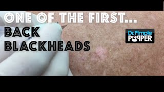 More Back Blackheads: One of my first patients I videotaped has returned!