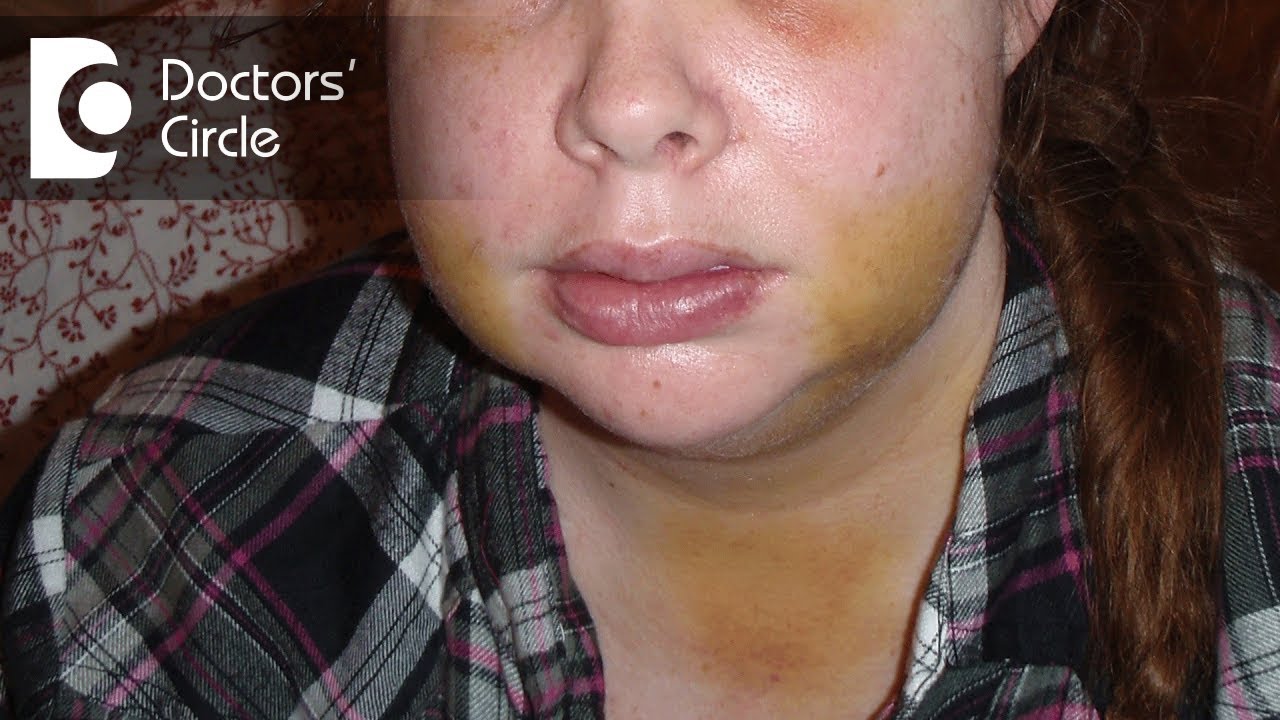 How Long Does Swelling Last After Wisdom Tooth Surgery Infoupdate Org