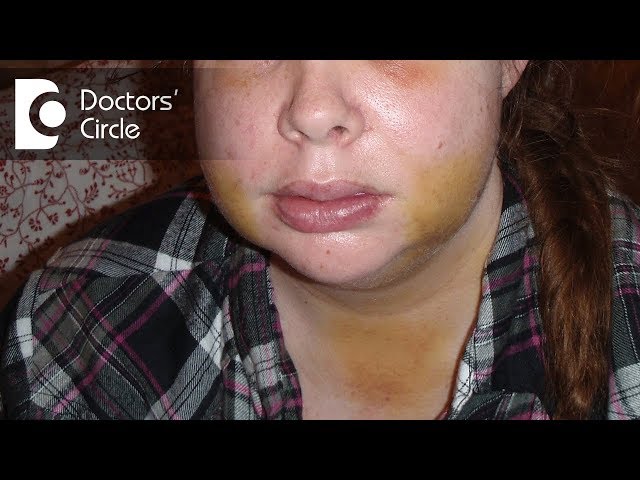 Wisdom Teeth Removal Swelling After 4 Days