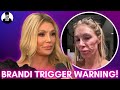 Trigger Warning | Brandi Glanville Shares Shocking Photos After Health Issues! #bravotv