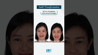 Transforming my smile with the magic of All-on-4 Implants case 8