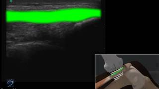 How To: Knee Quadriceps Tendon 3D Video