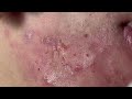 acne under skin p2 acne treatment mai ngoc da nang